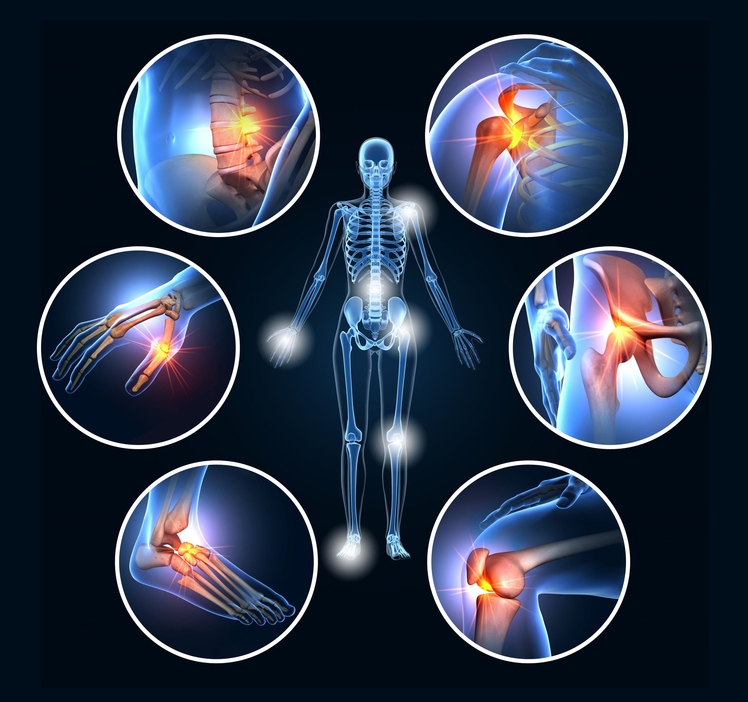 Arthritis graphic of inflamed joints