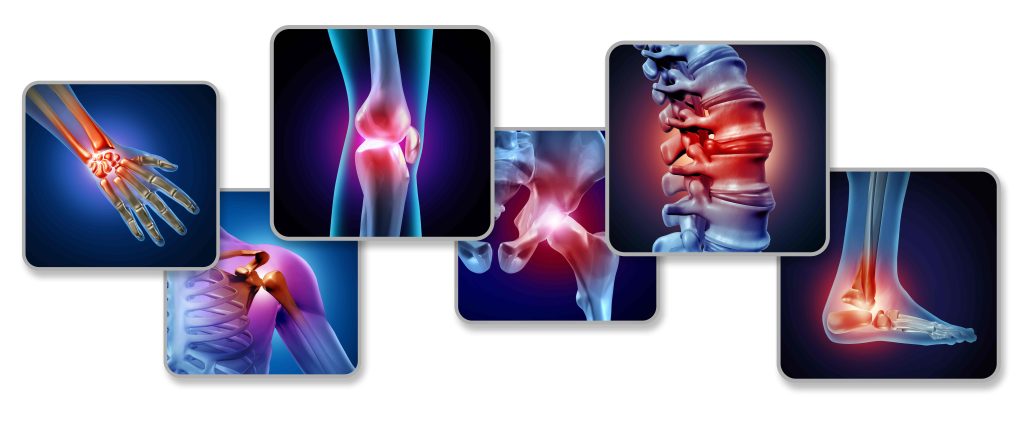 Graphic Illustration of Joint Arthritis