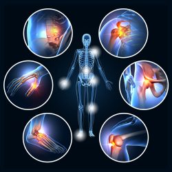 Arthritis graphic of inflamed joints